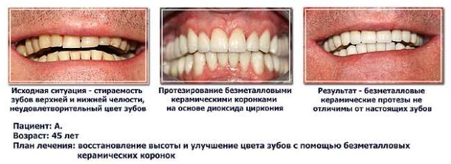 Clasicdent: Безметалловые технологии в стоматологии